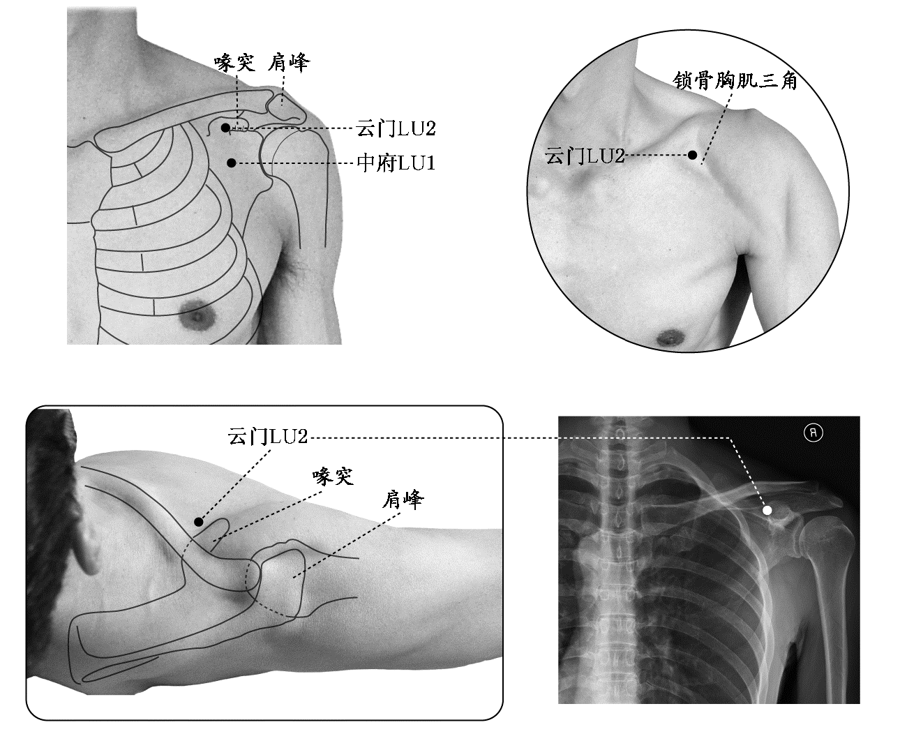 中府、云门的真人照片、解剖标记与X线对应位置图示